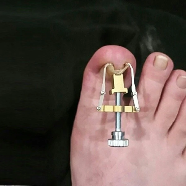 Ingrown Toenail Toe Fixer Recover Correction Device product thumbnail 13