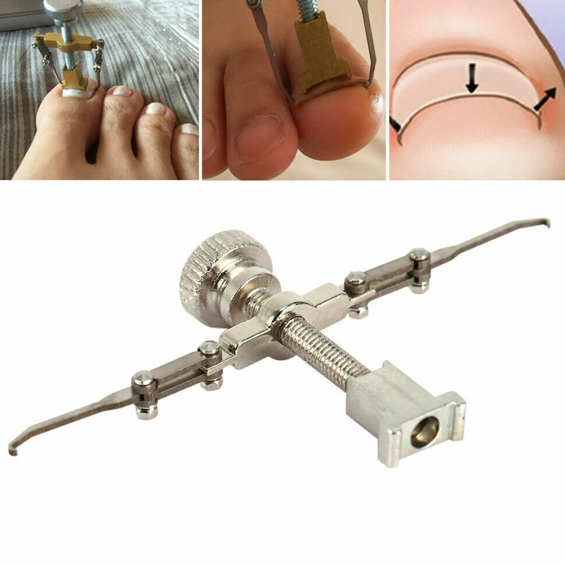 Ingrown Toenail Toe Fixer Recover Correction Device product thumbnail 16