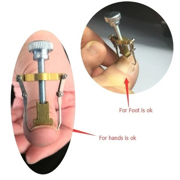 Ingrown Toenail Toe Fixer Recover Correction Device product thumbnail 12