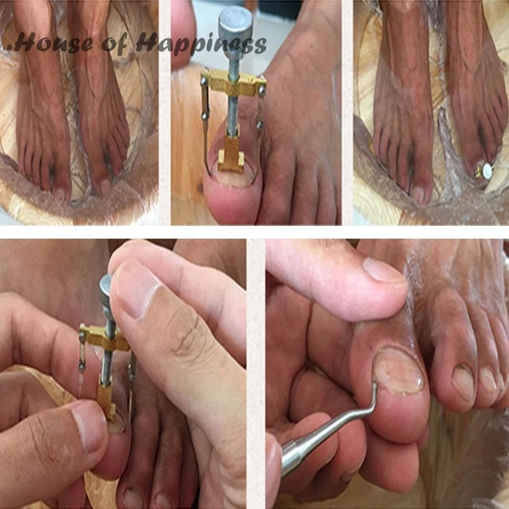 Ingrown Toenail Toe Fixer Recover Correction Device product thumbnail 15